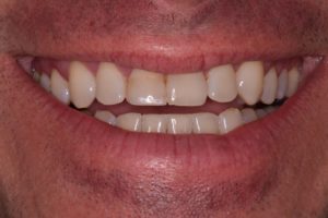 Smile photo before cosmetic dentistry procedure