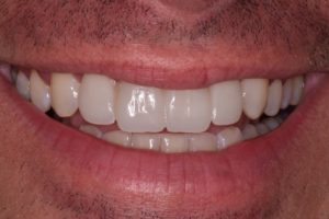 Smile photo before cosmetic dentistry procedure