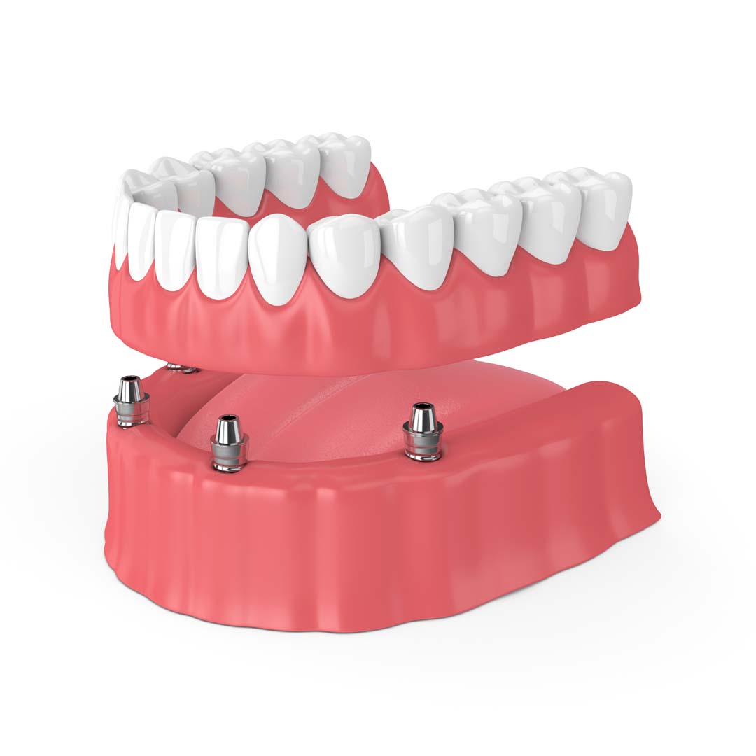 Decoding All-on-Four Implants
