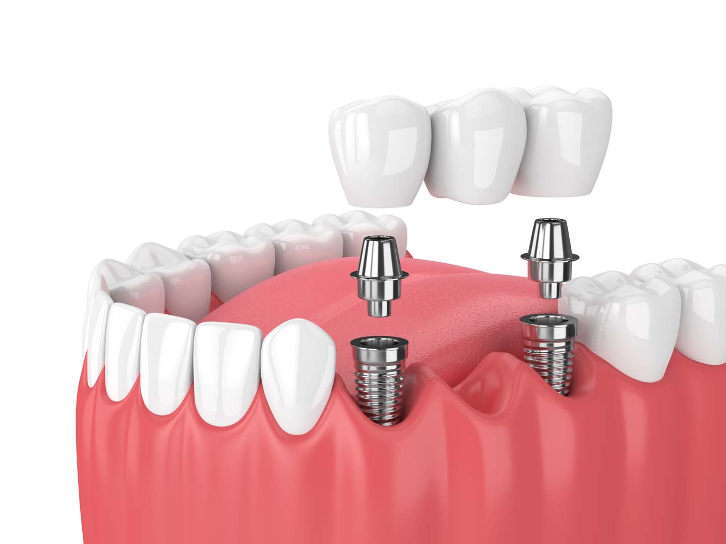 Advantages of Dental Implants